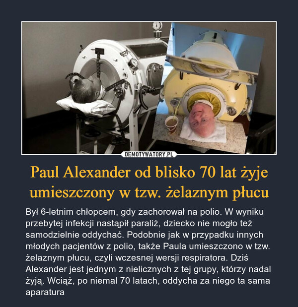 Paul Alexander od blisko 70 lat żyje umieszczony w tzw. żelaznym płucu – Był 6-letnim chłopcem, gdy zachorował na polio. W wyniku przebytej infekcji nastąpił paraliż, dziecko nie mogło też samodzielnie oddychać. Podobnie jak w przypadku innych młodych pacjentów z polio, także Paula umieszczono w tzw. żelaznym płucu, czyli wczesnej wersji respiratora. Dziś Alexander jest jednym z nielicznych z tej grupy, którzy nadal żyją. Wciąż, po niemal 70 latach, oddycha za niego ta sama aparatura 